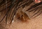 هل تعلم ماذا يحدث لرأس الإنسان إذا سكنت في شعره قملة لمدة شهر كامل دون أن يتخلص منها ؟