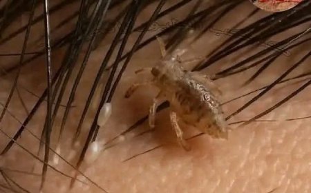 هل تعلم ماذا يحدث لرأس الإنسان إذا سكنت في شعره قملة لمدة شهر كامل دون أن يتخلص منها ؟