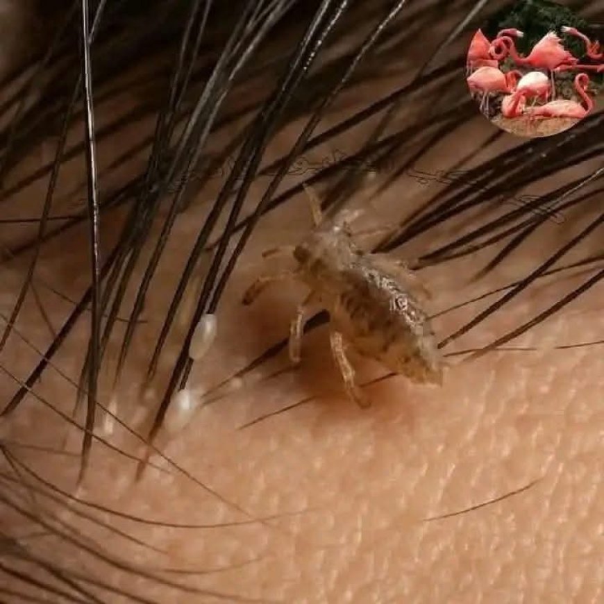 هل تعلم ماذا يحدث لرأس الإنسان إذا سكنت في شعره قملة لمدة شهر كامل دون أن يتخلص منها ؟